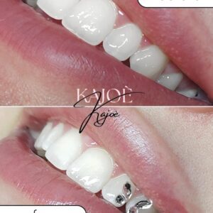 Hammaskorukoulutukset